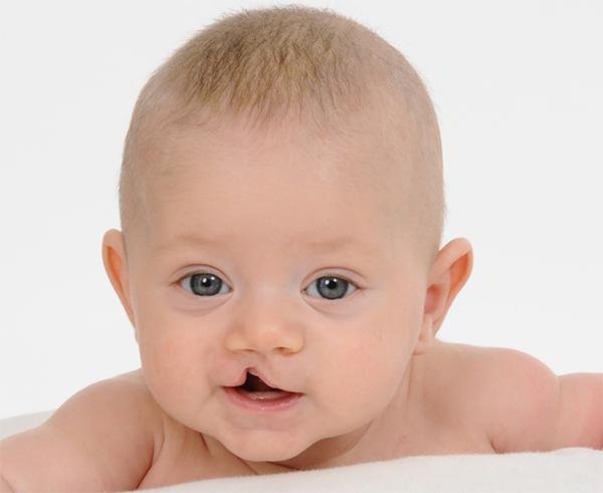 Mang lại nụ cười cho trẻ bị dị tật khe hở môi – vòm miệng