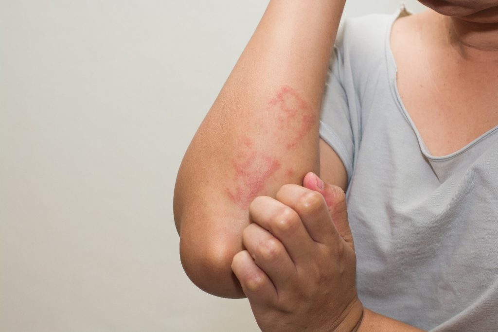 Phòng tránh và giảm nhẹ các triệu chứng dị ứng