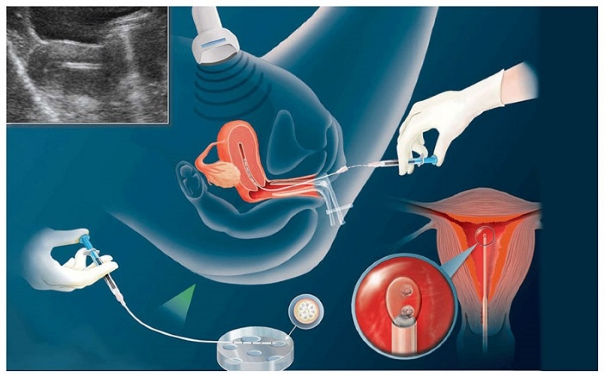 Đề xuất bảo hiểm y tế hỗ trợ chi phí điều trị vô sinh, hiếm muộn