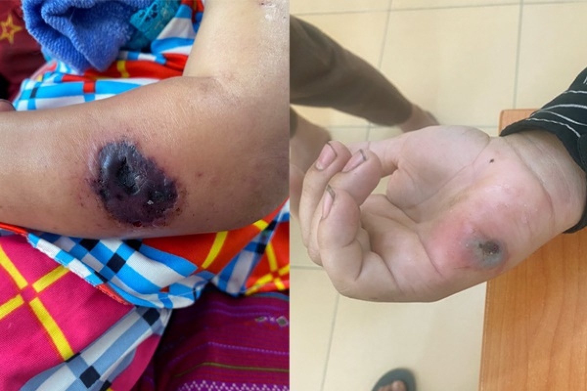 Chủ động phòng ngừa bệnh than lây nhiễm từ trâu bò