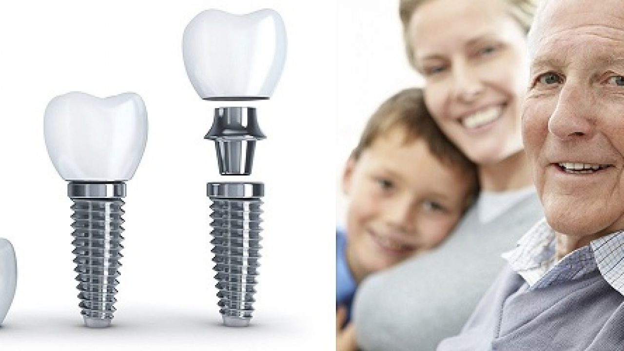 Cấy ghép răng bằng phương pháp Implant cho người cao tuổi