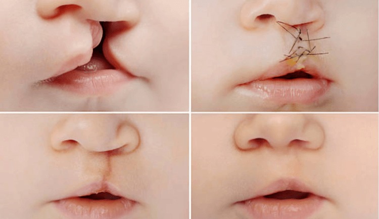 Nguyên nhân dẫn đến dị tật hở môi, vòm miệng và dị tật hàm mặt ở trẻ