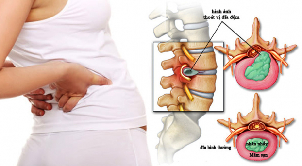 Các phương pháp điều trị bệnh thoát vị đĩa đệm