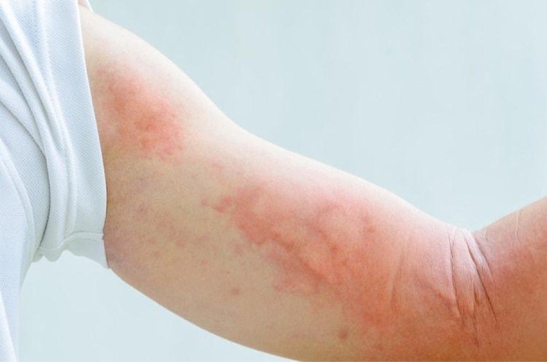 Tìm hiểu và kiểm soát tình trạng men gan tăng