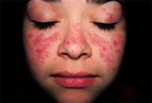 Người bị lupus ban đỏ hệ thống cần lưu ý gì để sống chung với bệnh