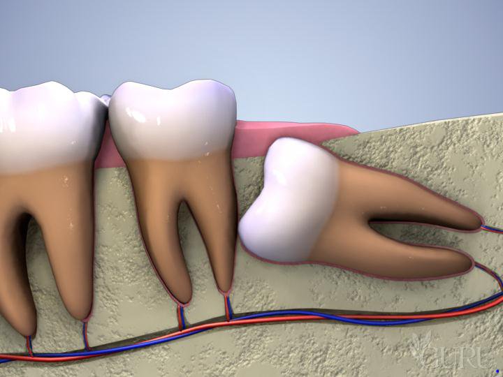 Cách xử trí khi gặp biến chứng từ những chiếc răng khôn mọc lệch