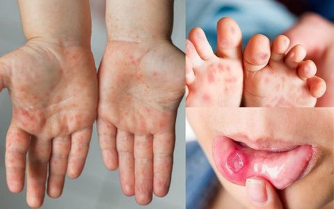  3 dấu hiệu cảnh báo trẻ mắc tay chân miệng trở nặng