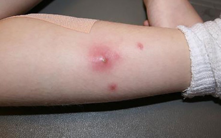 Phòng và điều trị bệnh viêm da mủ đúng cách