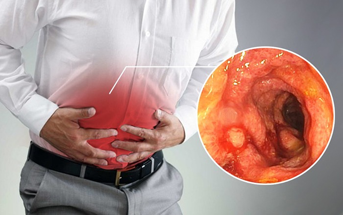 Phòng và điều trị bệnh viêm đại tràng